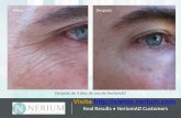 Los resultados de Nerium, la crema que elimina daños de la piel
