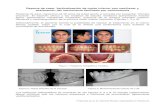 Reporte de caso: Verticalización de molar inferior con cantilever y aceleración del movimiento facilitado por corticotomía