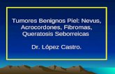 Tumores Benignos Piel: Nevus, Acrocordones, Fibromas, Queratosis Seborreicas Dr. López Castro.