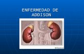 ENFERMEDAD DE ADDISON. DEFINICION La Enfermedad de Addison es una deficiencia hormonal causada por daño a la glándula adrenal lo que ocasiona una hipofunción.