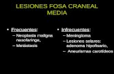 LESIONES FOSA CRANEAL MEDIA Frecuentes: –Neoplasia maligna nasofaringe, –Metástasis Infrecuentes: –Meningioma –Lesiones selares: adenoma hipofisario, –