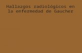 Hallazgos radiológicos en la enfermedad de Gaucher.