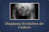 Displasia Evolutiva de Cadera. Generalidades Factores de riesgo Diagnóstico Prevención.