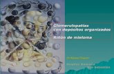 Glomerulopatías con depósitos organizados Riñón de mieloma Dr Manuel Vaquero Hospital Donostia San Sebastián San Sebastián.