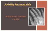 Artritis reumatoide Mario Uceda