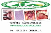 Tumores nasosinusales - Otorrinolaringologia
