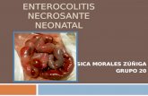 Enterocolitis necrosante neonatal