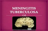 Meningitis tuberculosa de cynthia