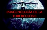Radiología de la tuberculosis
