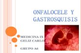 Gastrosquisis y Onfalocele