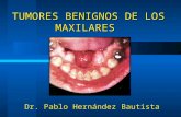 tumores benignos de los maxilares