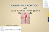 Diagnóstico de aneurisma aórtico torácico por TC