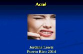 Tratamiento de acne e Piel Grasosa 2014