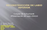 Reconstrucción Labio Inferior. Dr. Gaspar Marcello