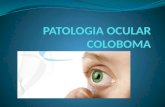Coloboma congenito y desarrollo embriologico del ojo
