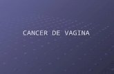 Cancer de vagina