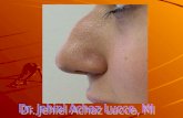 Anatomia nasal - epistaxis