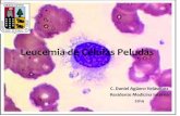 Leucemia Celulas Peludas. Tricoleucemia
