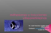 Adhesiones y tracciones_vitreorretinianas2