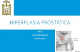 Hiperplasia prostática
