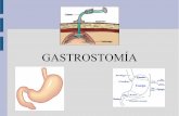 Gastrostomía: Definición, indicaciones, tipos, cuidados y complicaciones.