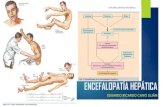 Encefalopatía hepática & caso clínico