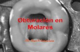 OBTURACION EN MOLARES