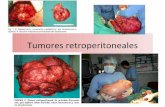 Tumores retroperitoneales