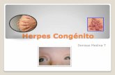 Herpes congenito