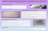 Presentación 079: INFARTO AGUDO DE MIOCARDIO POR INGESTA DE COCAINA.