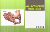 Cirugía Pediátrica - Malrotación intestinal