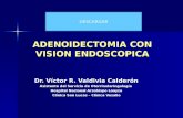 Adenoidectomia con vision endoscopica