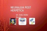Neuralgia post herpética