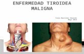 Cancer de tiroides