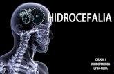 Hidrocefalia full