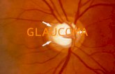 Glaucoma generalidades