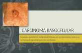 Carcinoma basocelular 2015
