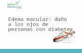 Edema macular: daño a los ojos de personas con diabetes