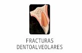 Fracturas Dentoalveolares- Parte Karen