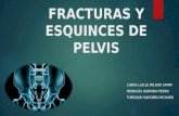 Fracturas y Esquinces de Pelvis