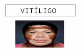 Vitiligo Ppt