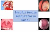 Insuficiencia Respiratoria Nasal