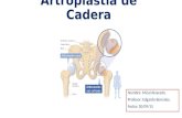 Artroplastia de Cadera