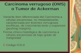 Carcinoma verrugoso (OMS) o Tumor de Ackerman Variante bien diferenciada del Carcinoma a células escamosas, no metastatizante, caracterizada por lesiones.