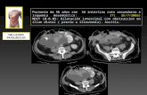 Paciente de 56 años con Sd intestino coto secundario a isquemia mesentérica: IT( 25/7/2005) MDCT 10-8.05: Dilatación intestinal con obstruccion en ilion.