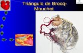 Tri á ngulo de Brocq-Mouchet