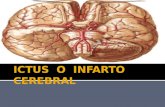 ICTUS  O  INFARTO CEREBRAL