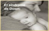 El síndrome de Down: