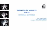 EMBOLIZACIÓN CON ONYX DE MAV CEREBRAL IZQUIERDA