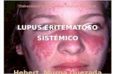 Lupus Eritomatoso Sistemico